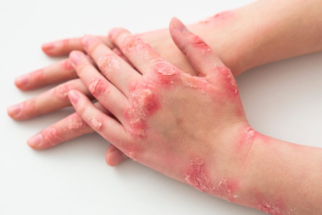 Tout savoir sur le psoriasis et ses formes – Collex : Toutes Les ...
