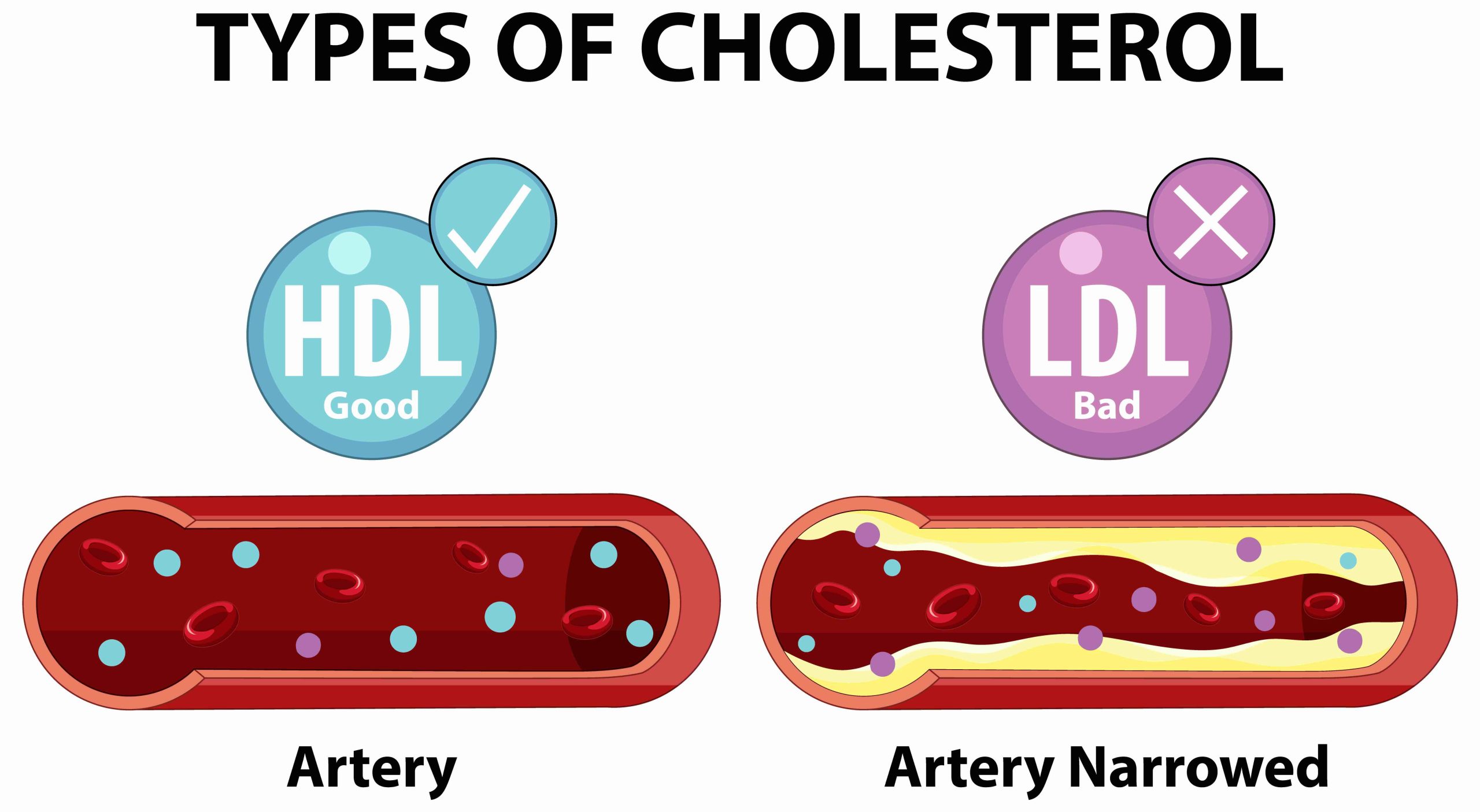 cholestérol élevé
